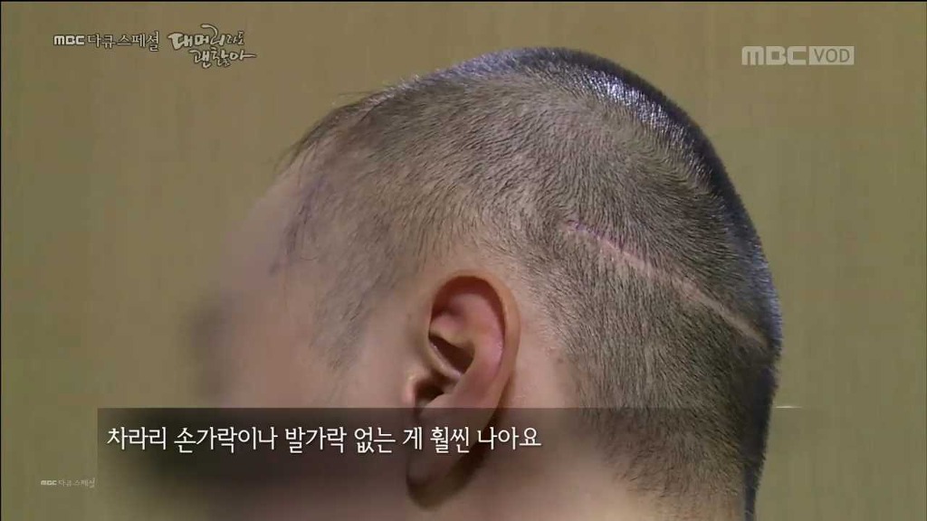 탈모 환자가 받는 스트레스... | 인스티즈