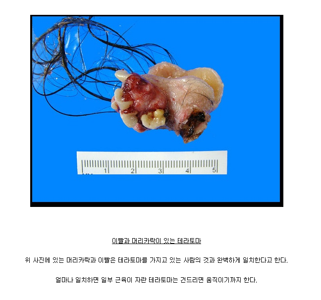 사람을 닮은 기괴한 암덩어리 테라토마 *혐오주의 | 인스티즈