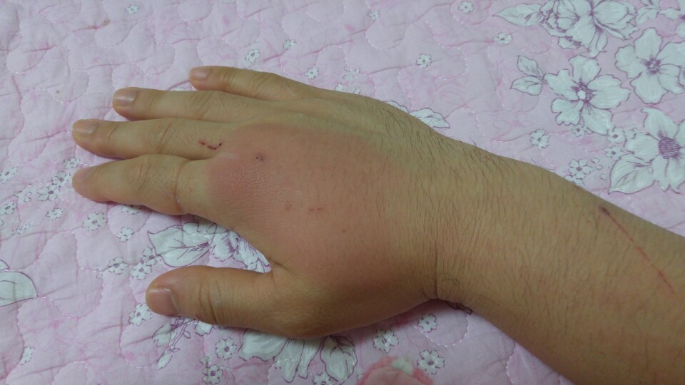 고양이한테 물리면 바로 병원가야하는 이유 | 인스티즈